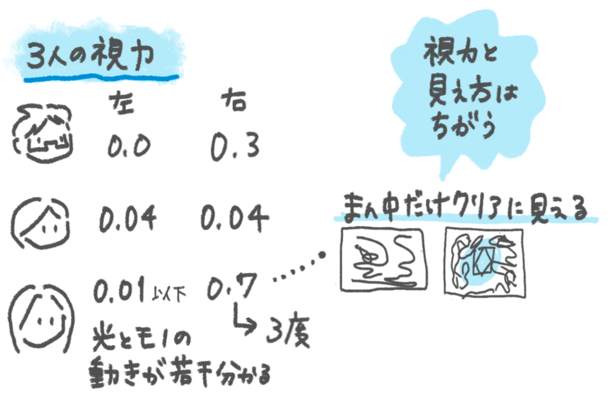 イラスト：3人の視力 谷田さん：左0.0 右0.3 あさひさん：左0.04 右0.04 マキさん：左0.01以下 右0.7 左目は光とモノの動きが若干分かる程度。右目の中心視野は3度で、まん中だけクリアに見える。（視力と見え方はちがう）